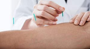 arm-acupuncture