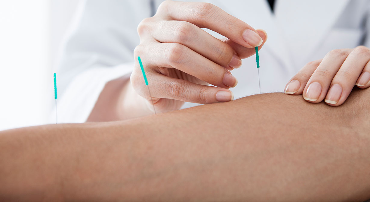 arm-acupuncture